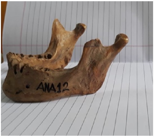 Morphological study of variation in shape of coronoid process of mandible in dry human bone in Mahakaushal region