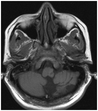 A case of lateral medullary syndrome with unilateral selective thermoanaesthesia