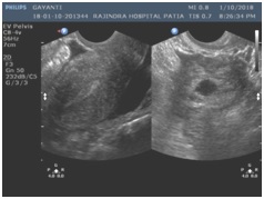 Role of grey scale ultrasound and Colour Doppler findings to differentiate ectopic pregnancy from corpus luteum cyst of pregnancy
