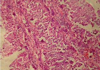 A rare case of extensive idiopathic scrotal calcinosis