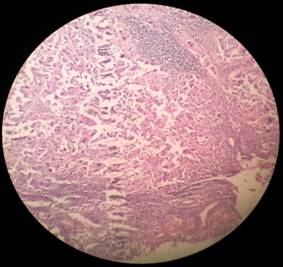 A Rare Case of Fibrolamellar Hepatocellular Carcinoma with Unusual Presentation in a Young Indian Female- a case report