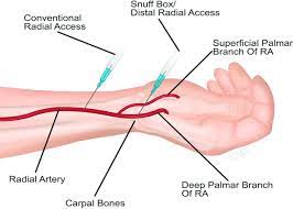 Transradial access through the anatomical snuffbox: Results of a  feasibility study - ScienceDirect