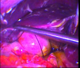 Laparoscopic repair of peptic ulcer perforation:Our experience