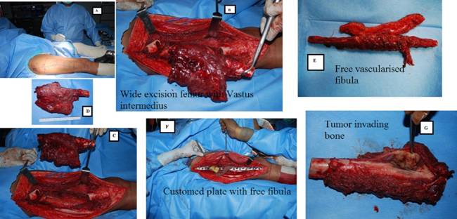 Limb salvage in epithelioid sarcoma like hemangioendothelioma invading femur mid shaft: a case report