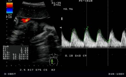 Best color Doppler indices in prediction of fetal hypoxia in IUGR fetuses