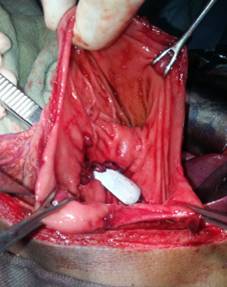Traumatic double gastric rupture-a rare finding in blunt trauma abdomen