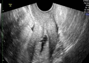 Role of saline infusion sonography in patients with infertility and comparison of the same with transvaginal ultrasonography