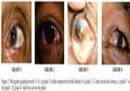 A clinical study of comparison of pterygium surgery with and without Mitomycin- C on bare sclera technique