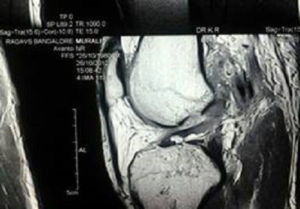 A quadrupled semitendinosus only anterior cruciate ligament reconstruction with tibial suspensory fixation