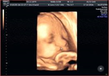 Importance of ultrasound investigation in the early prenatal diagnosis of an Oral-Facial-Digital Syndrome Type I: a new case report