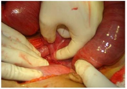Acute intestinal obstruction during pregnancy