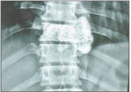 Giant cell tumour of dorsal spine presenting with mediastinal mass: a rare case report