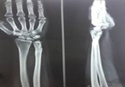 Tuberculosis of the distal ulna mimicking malignanacy - a rare case report