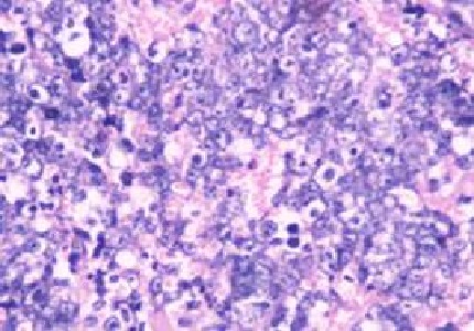 T-Cell Lymphoma of Oral Cavity: A Case Report