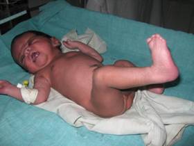 Apert syndrome: A Case report