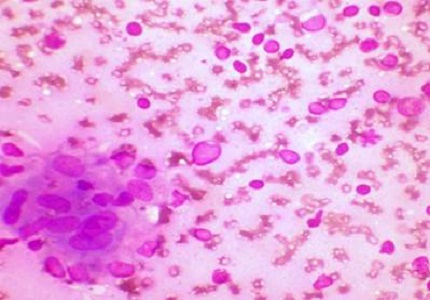 Fine needle aspiration cytology in the diagnosis of Tuberculous lymphadenitis and utility of Ziehl Neelsen stain benefits and pitfalls