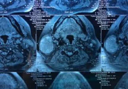 Extra-capsular Parotid Tumor Dissection