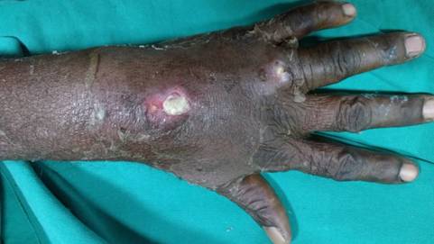 Self subcutaneous injection of profenophos with delayed systemic toxicity: a case report
