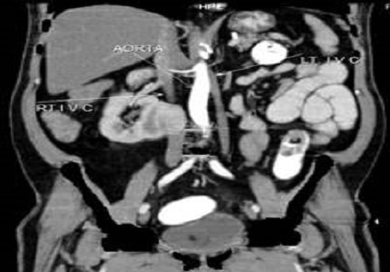 Double inferior vena cava with L-type crossed fused renal ectopia: A rare case report