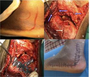 Outcome of Calcaneal Platting after fracture:  two year follow-up