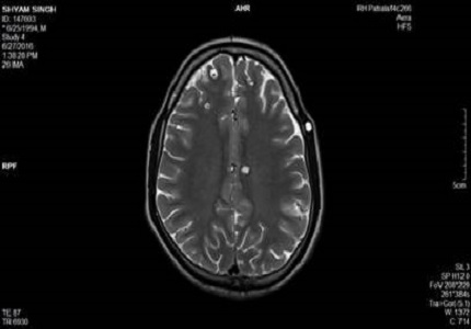 Extensive disseminated cysticercosis with involvement of all possible rare sites in a single patient – MRI and USG diagnosis