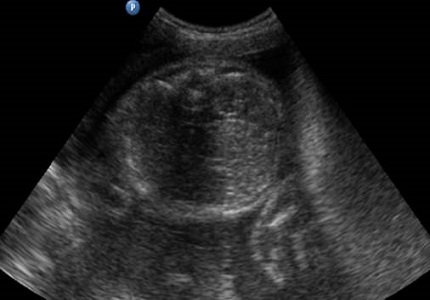 Antenatal diagnosis of oesophageal atresia with tracheoesophageal fistula with upper neck pouch sign-A radiological study
