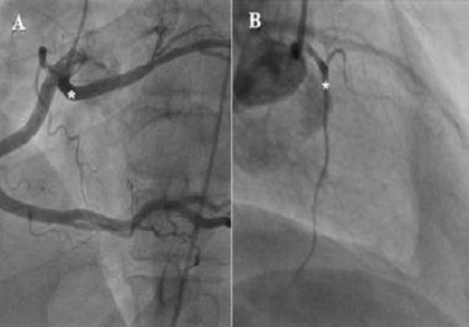 Distribution of Coronary Artery Anomalies and Their Evaluation with Different Imaging Modalities