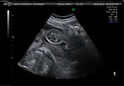 Early prenatal ultrasonographic diagnosis and follow up treatment of a giant abdominal hemangioma: a rare case report