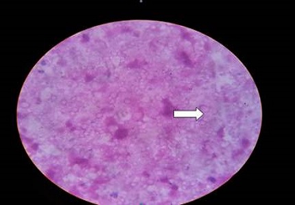 Adrenal histoplasmosis in an immunocompetant Individual– a rare case report