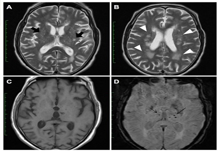 Role of susceptibility weighted imaging in characterization of intra-cranial lesions