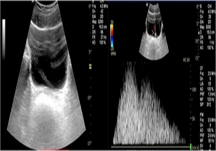 Utility of color Doppler in diagnosing ureteric calculi: a useful adjunct