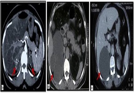Adrenal cysts-a report of four cases including one with bilateral involvement