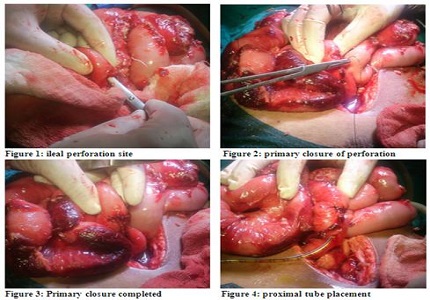 A retrospective comparative analysis of two different techniques of small bowel diversion in Ileal perforation cases: a single centre experience