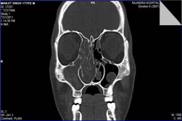 Comparison between preoperative computed tomography scan of paranasal sinuses and operative findings in functional endoscopic sinus surgery (FESS) in chronic sinusitis