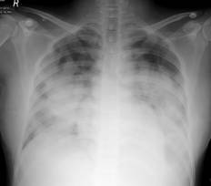 H1N1 influenza: Does chest radiograph have a role in predicting prognosis?
