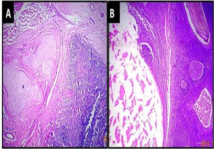 Histopathological spectrum of lesions of tonsil- A 2 year experience from tertiary care hospital of Maharashtra, India