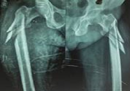Correlation of preoperative co-morbidities with post-operative outcomes in patients operated for hip fractures