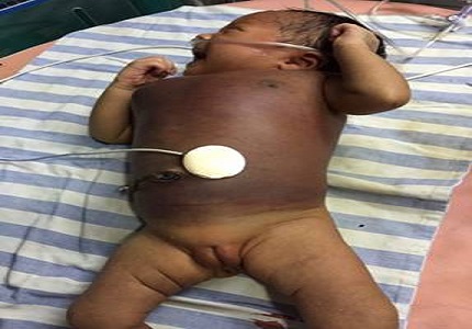 Neonatal Kasabach-Merritt Syndrome (KMS): case report