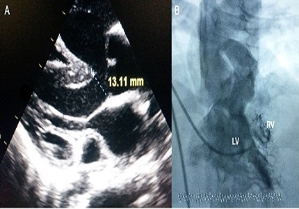Single coronary ostium, unilateral pulmonary atresia and MAPCA with tetralogy of fallot in a young adult: a rare association