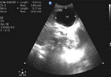 Comparative evaluation of ultrasonography and computed tomography findings in focal hepatic masses