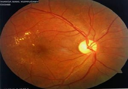 The relationship between blood sugar levels (glycosylated haemoglobin) and the risk of development of diabetic retinopathy