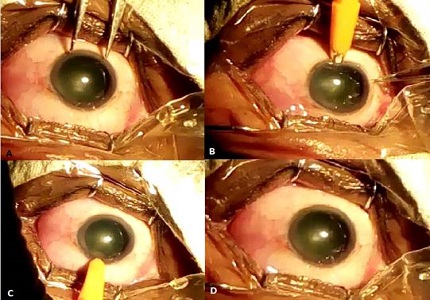 A study on efficacy of limbal relaxing incisions in correcting corneal astigmatism along with clear corneal phacoemulsification in a tertiary eye care centre in South India