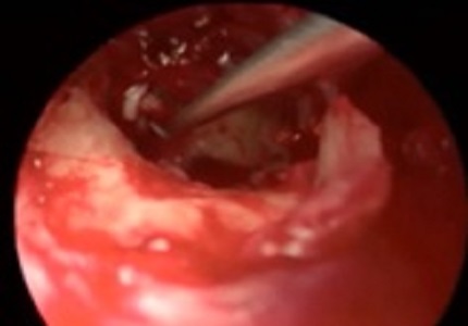 Endoscopic exploratory tympanotomy findings in conductive hearing loss: a surgical review