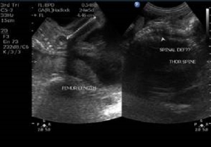 Ultrasound evaluation of fetal central nervous system anomalies and its correlation with postnatal outcome
