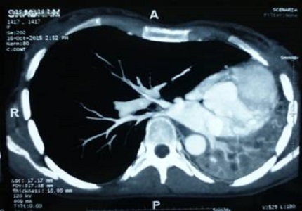 Hypoplasia of lung a rare entity mimicking as a case of tuberculosis