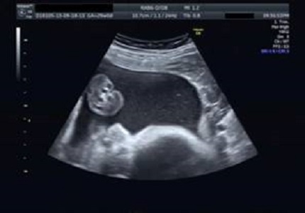The current role of imaging in the prenatal diagnosis of fetal achon-droplasia medical management and dental implications