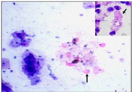 Spectrum of abnormal epithelial lesions of cervix in a tertiary care teaching  hospital  in  South India