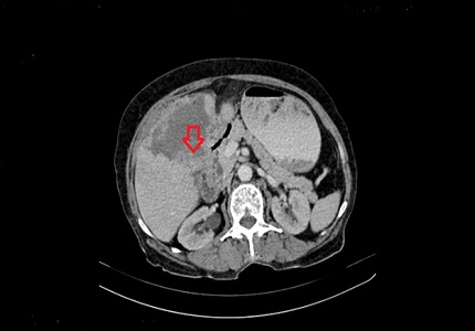 Spectrum of CT findings in gall bladder carcinoma patients in north Indian population
