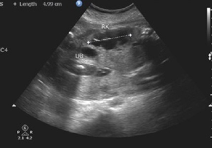 Role of  ultrasound in diagnosis of fetal congenital abdominal anomalies: One year prospective study