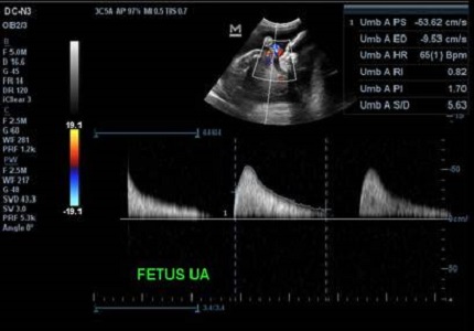 Doppler velocimetry in dichorionic twin pregnancies and its correlation with various fetal outcome